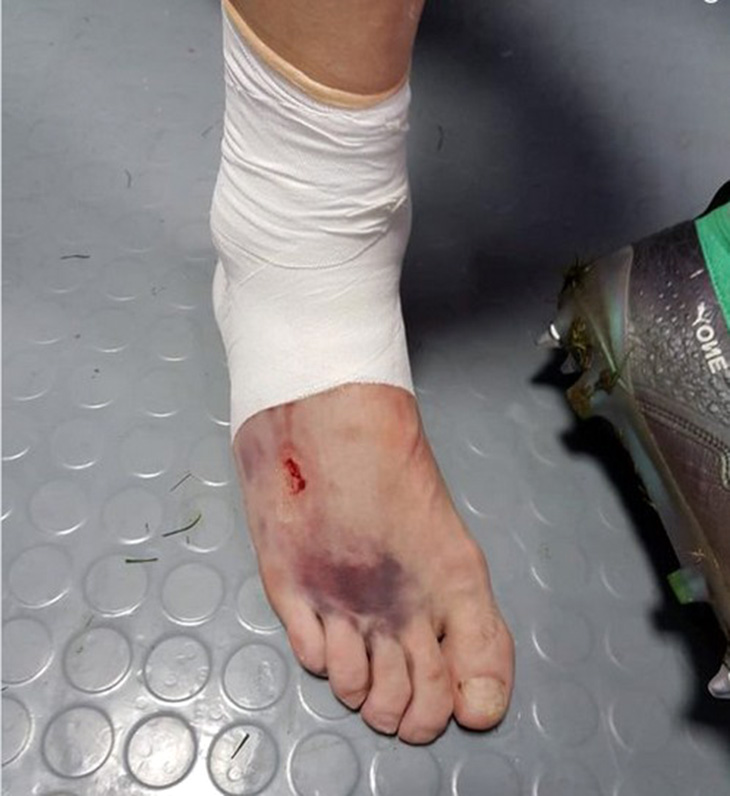 нога Кутепова после матча с Хорватией